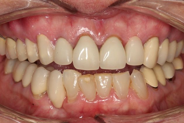 Full Mouth Rehabilitation Kathy - Before