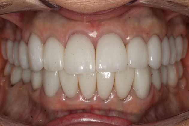Full Mouth Rehabilitation Linda - After