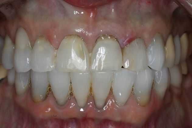 Full Mouth Rehabilitation Linda - Before