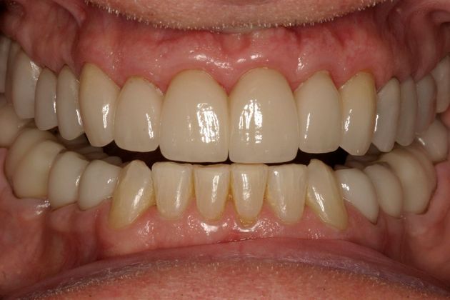 Full Mouth Rehabilitation Robert - After