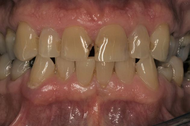 Full Mouth Rehabilitation Robert - Before