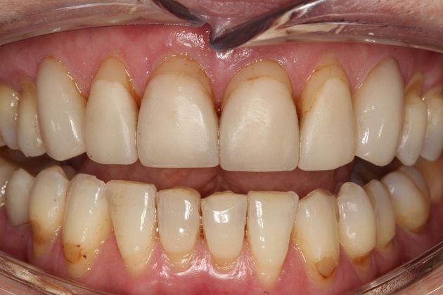 Full Mouth Rehabilitation Vicky - Before