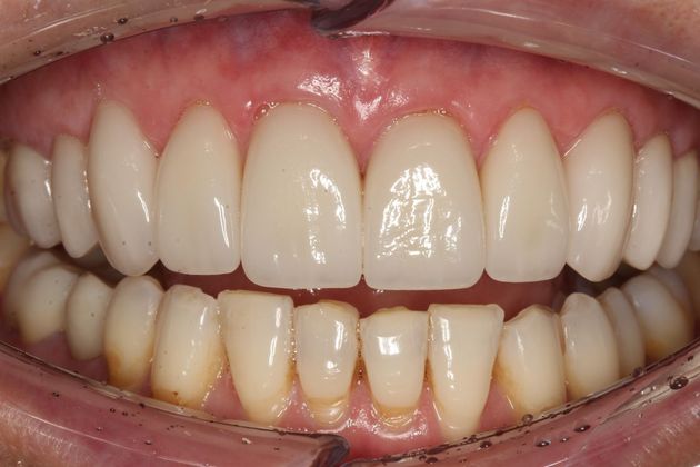 Full Mouth Rehabilitation Vicky - After