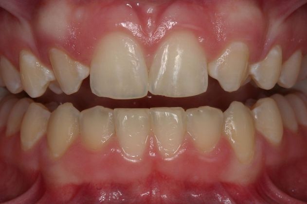 Cosmetic Bonding: Katelyn - Before