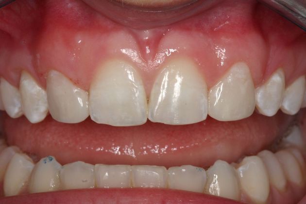 Cosmetic Bonding: Katelyn - After