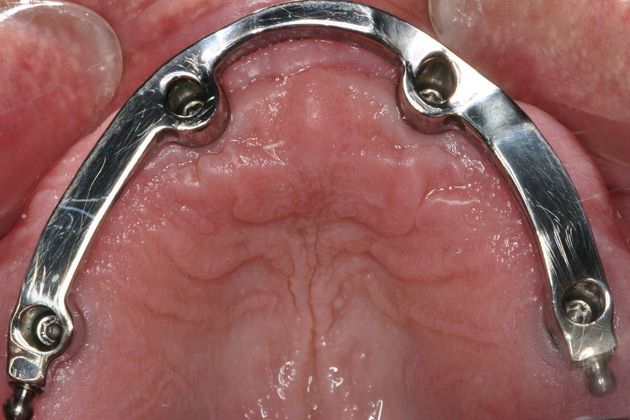 Implant Retained Overdentures Kirk - Before