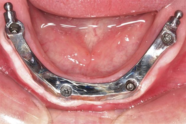 Implant Retained Overdentures: Kirk - Before