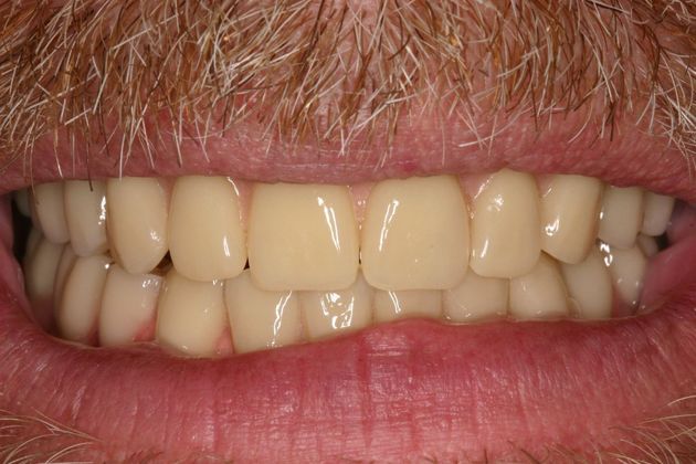 Implant Retained Overdentures: Kirk - After