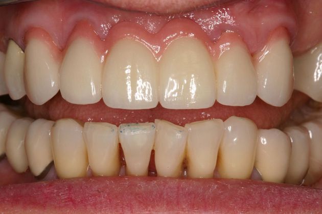 Crowns Lorna - After