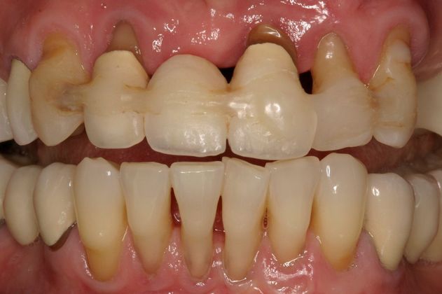 Crowns Lorna - Before