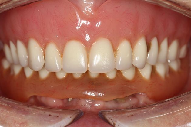 Mickey's teeth before overdentures