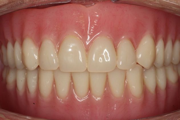 Mickey's teeth after overdentures