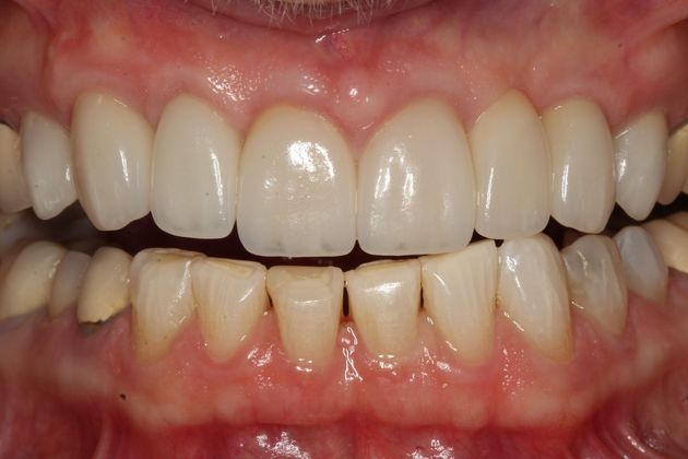 Implant Restorations Pat - After