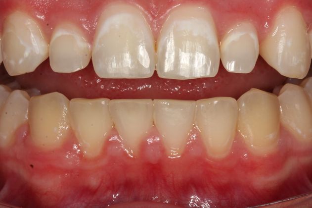 Cosmetic Bonding Tristan - Before