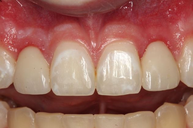 Cosmetic Bonding Tristan - After