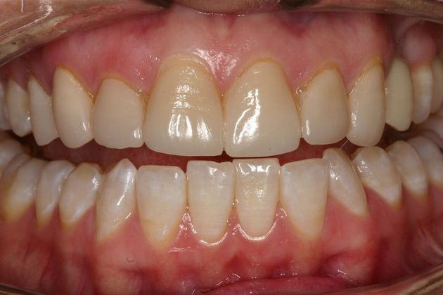 Veneers Sarah - Before