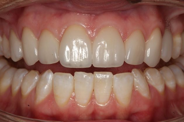 Veneers Sarah - After