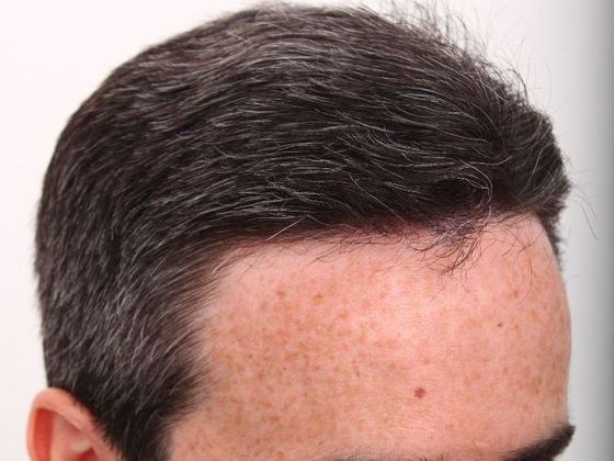 best fue hairline nyc - Male Before And After Hair Transplant Photos -  Before and After Gallery