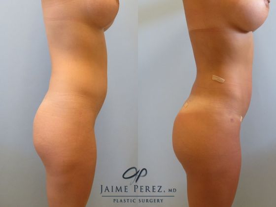 Before & After