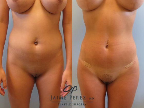 Before & After