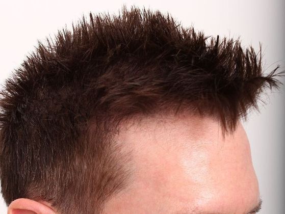 Male Before And After Hair Transplant Photos: Hairline FUE (9) - After FUE hair transplant