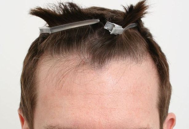 Male Before And After Hair Transplant Photos: Hairline FUE (9) - Before FUE hair transplant