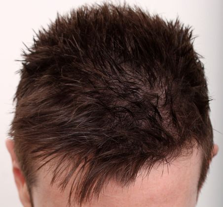Male Before And After Hair Transplant Photos: Hairline FUE (9) - After FUE hair transplant