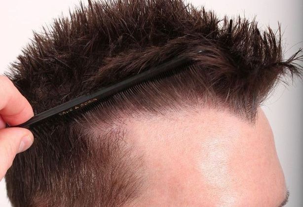 Male Before And After Hair Transplant Photos: Hairline FUE (9) - After FUE hair transplant