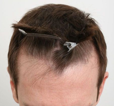 Male Before And After Hair Transplant Photos: Hairline FUE (9) - Before FUE hair transplant