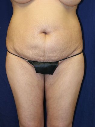 Brazilian Butt Lift : Case 1 - Before