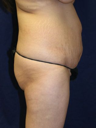 Brazilian Butt Lift : Case 1 - Before