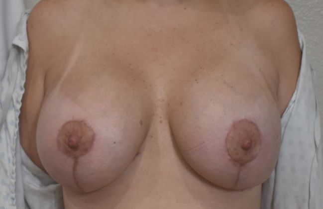 Breast Augmentation w/ Lift: Case 331 - After