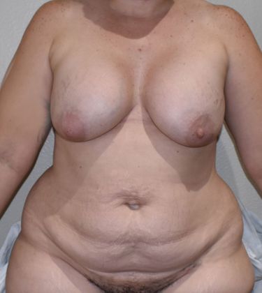 Mommy Makeover Case 169 - Before