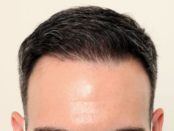 Male Before And After Hair Transplant Photos Frontal FUE (2) - After