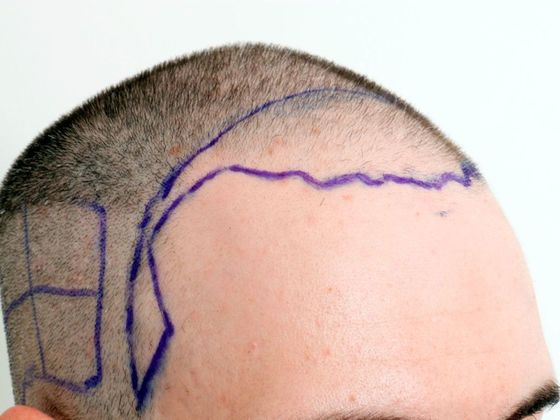 Hair Transplant - Male: Frontal FUE - Case 25 - Before FUE hair transplant