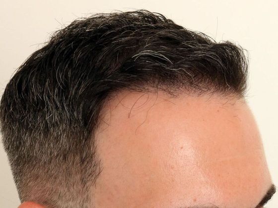 Hair Transplant - Male: Frontal FUE - Case 25 - After FUE hair transplant