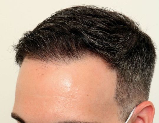 Hair Transplant - Male: Frontal FUE - Case 25 - After FUE hair transplant