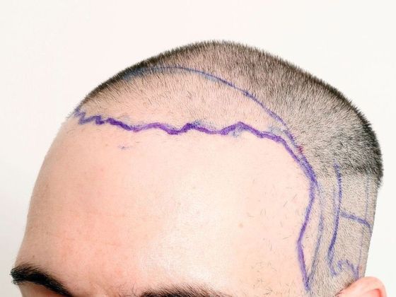 Hair Transplant - Male: Frontal FUE - Case 25 - Before FUE hair transplant