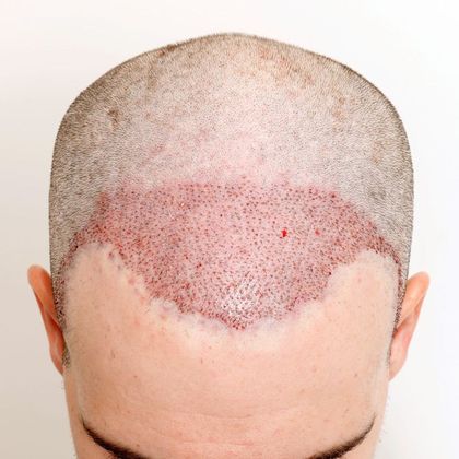 Hair Transplant - Male: Frontal FUE - Case 25 - Post-op FUE hair transplant
