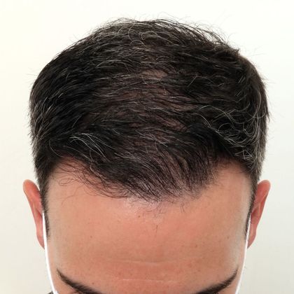 Hair Transplant - Male: Frontal FUE - Case 25 - After FUE hair transplant