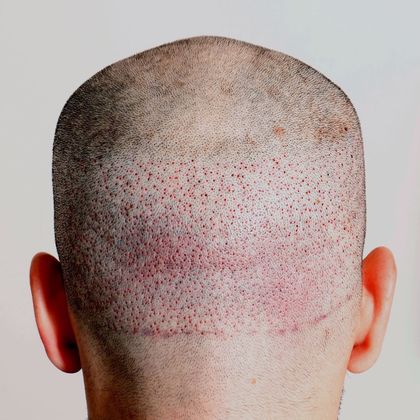 Hair Transplant - Male: Frontal FUE - Case 25 - Post-op FUE hair transplant