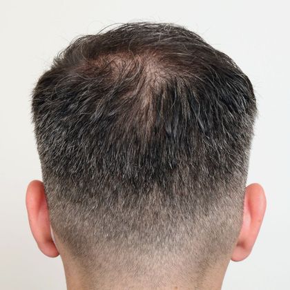 Hair Transplant - Male: Frontal FUE - Case 25 - After FUE hair transplant