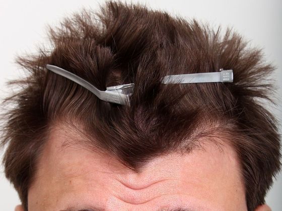 Male Before And After Hair Transplant Photos Hairline FUE (10) - Before