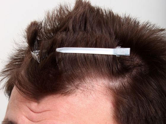 Hair Transplant - Male: Hairline FUE - Case 10 - Before FUE hair transplant