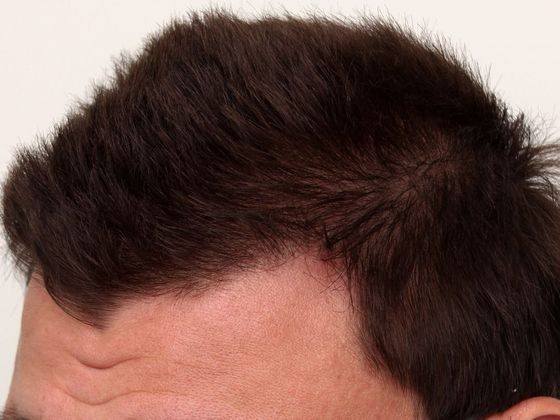 Hair Transplant - Male: Hairline FUE - Case 10 - After FUE hair transplant