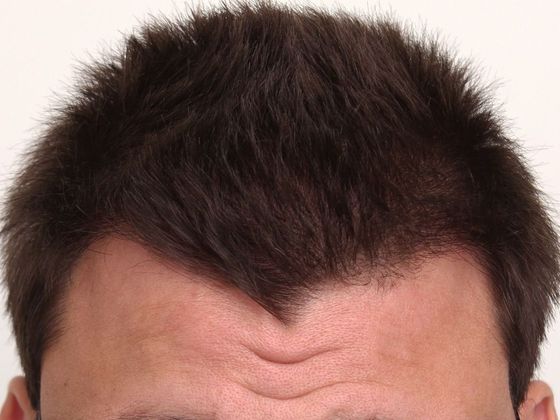 Male Before And After Hair Transplant Photos Hairline FUE (10) - After