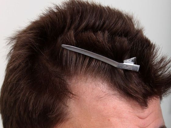 Hair Transplant - Male: Hairline FUE - Case 10 - Before FUE hair transplant