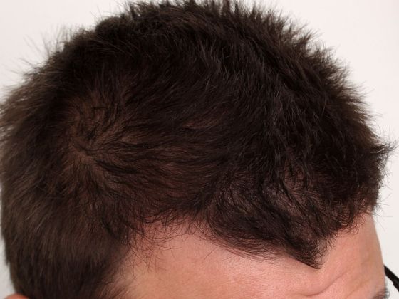 Hair Transplant - Male: Hairline FUE - Case 10 - After FUE hair transplant