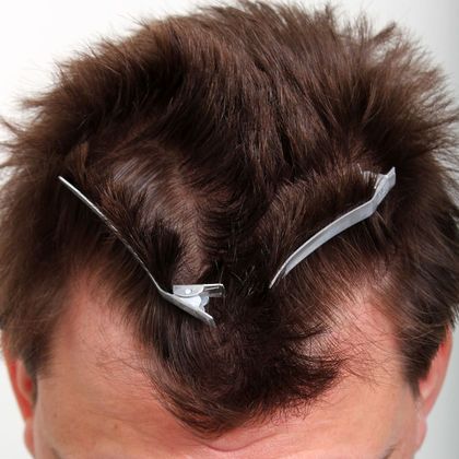 Hair Transplant - Male: Hairline FUE - Case 10 - Before FUE hair transplant