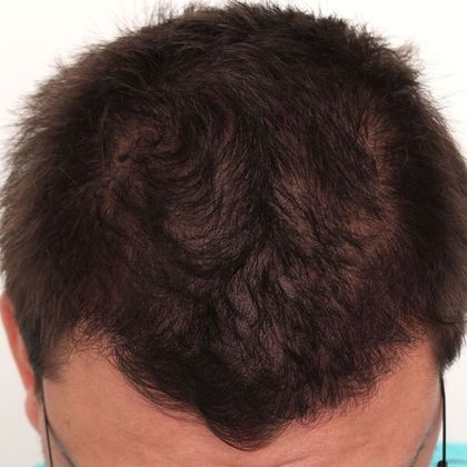 Hair Transplant - Male: Hairline FUE - Case 10 - After FUE hair transplant